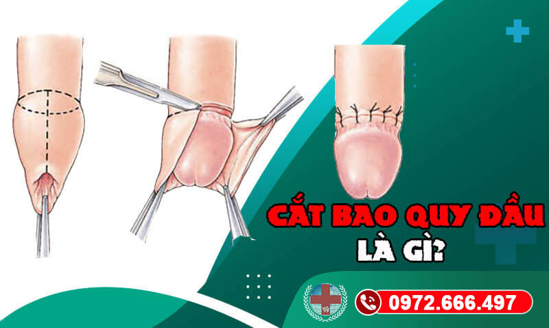 Tổng quan cắt bao quy đầu