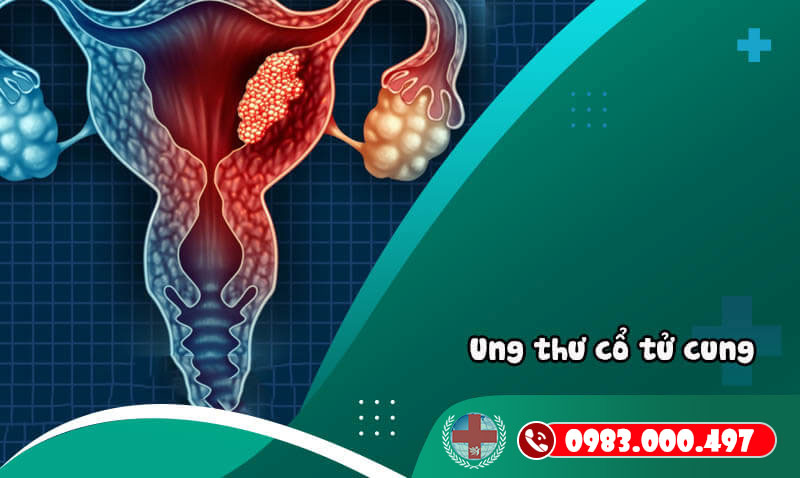 Các bệnh cổ tử cung thường gặp 2
