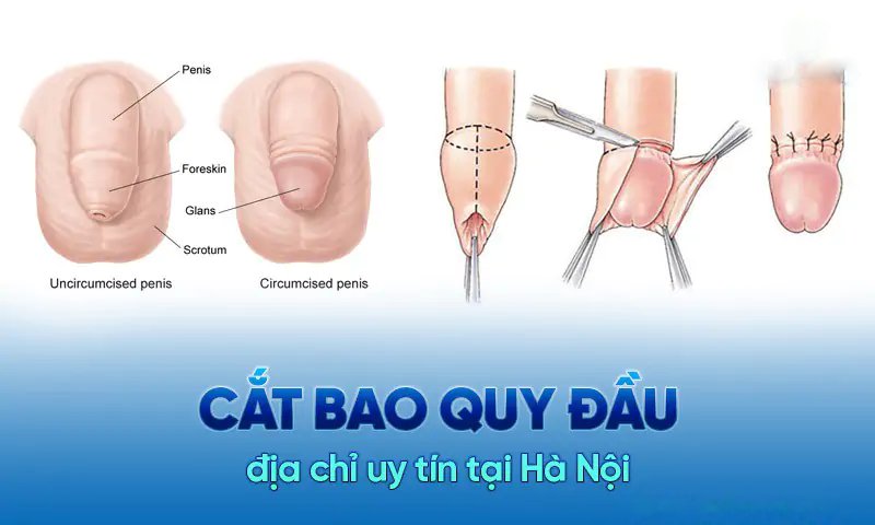 Cắt bao quy đầu ở đâu uy tín?