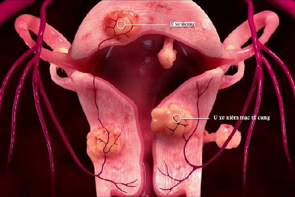 Hình ảnh u xơ tử cung và cách điều trị hiệu quả