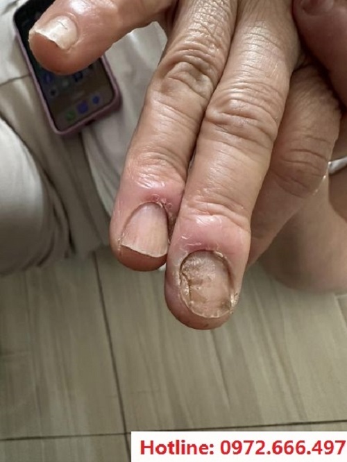 Nấm móng tay chân: Nguyên nhân, triệu chứng và cách điều trị