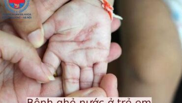Bệnh Ghẻ Nước Ở Trẻ Em Lây Lan Như Thế Nào?