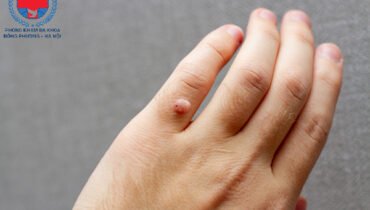 Mách Bạn Những Cách Trị Mụn Cóc Ở Tay Hiệu Quả